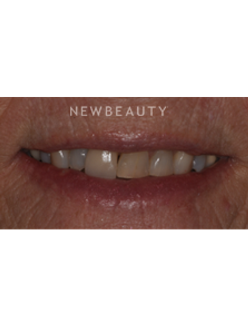 Dr. Sara Cummins - Smile Makeover - Before