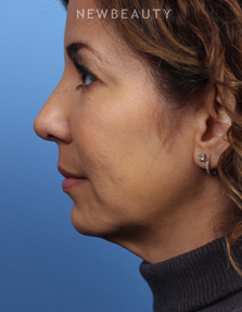 Dr. James Bouzoukis - Restylane - After