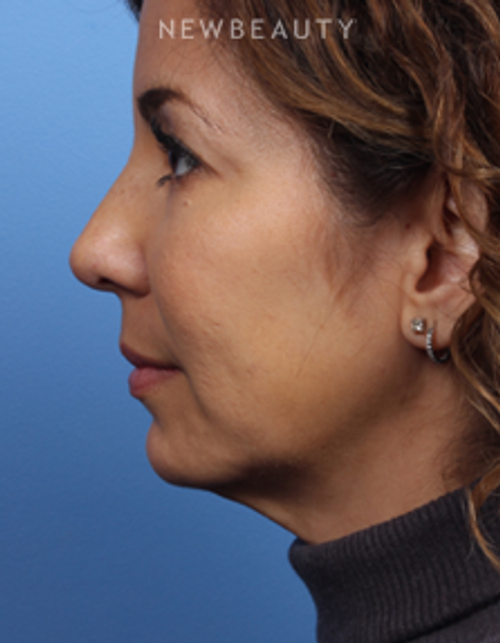 Dr. James Bouzoukis - Restylane - After