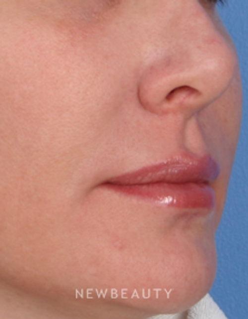 Dr. Kelly Bomer, Lip Enhancement - After