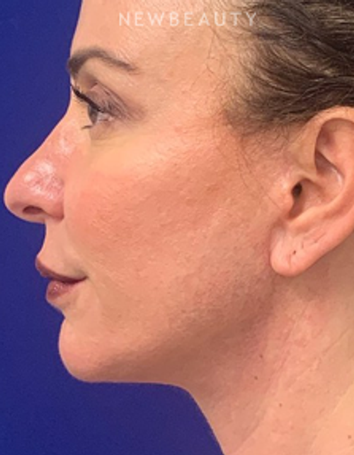 Dr. Dilip Madnani - Facial Rejuvenation - After