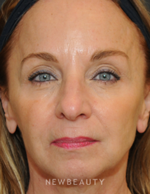 Dr. Janet Allenby - Facial Rejuvenation - After