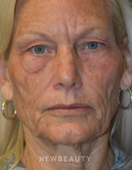 Drs. Lieberman & Parikh - Facelift - Before
