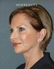 Dr. Min S. Ahn- Facelift - After