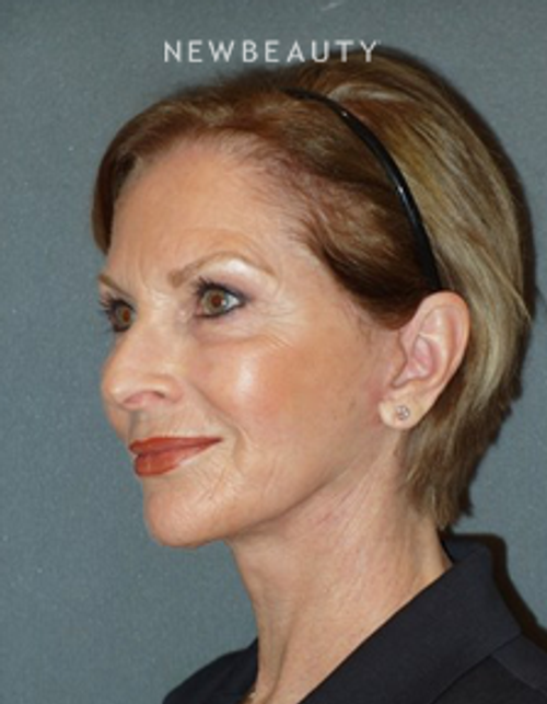 Dr. Min S. Ahn- Facelift - After