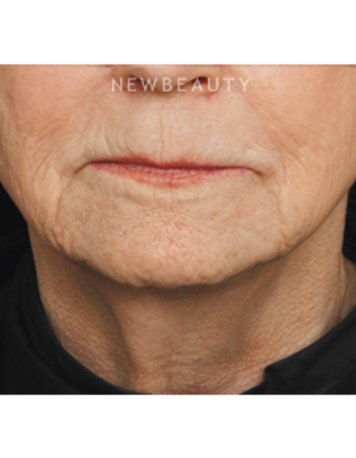 Drs. Jennifer Segal & Scott Smith - Injectables & Fillers - Before