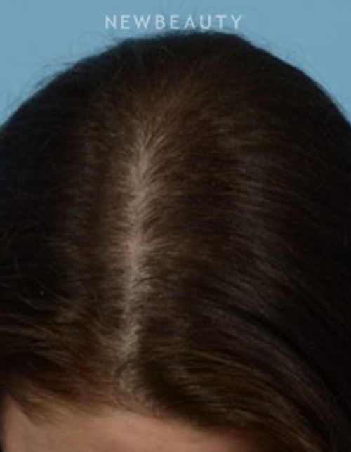 Dr. Jeffrey Wise - Hair-Loss Treatment - After