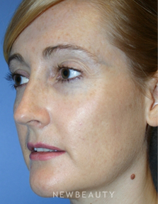 Dr. Kelly Bomer -  Chemical Peels - After