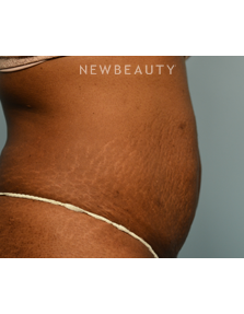 Dr. Ruth Hillelson - Thermage - Before