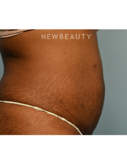 Dr. Ruth Hillelson - Thermage - Before