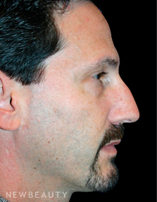 Dr. Kelly Bomer Rhinoplasty - Before
