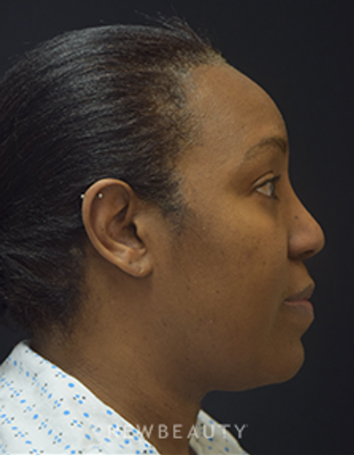 Dr. Jeffrey B. Wise - Lipo & Rhinoplasty - Before