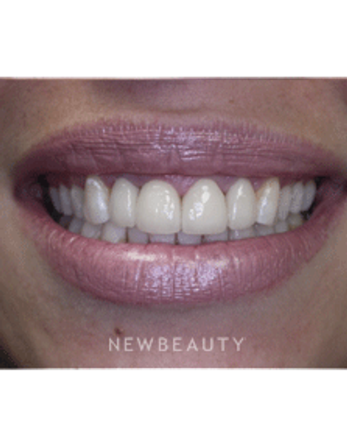 Dr. Irene Grafman Smile Makeover - After