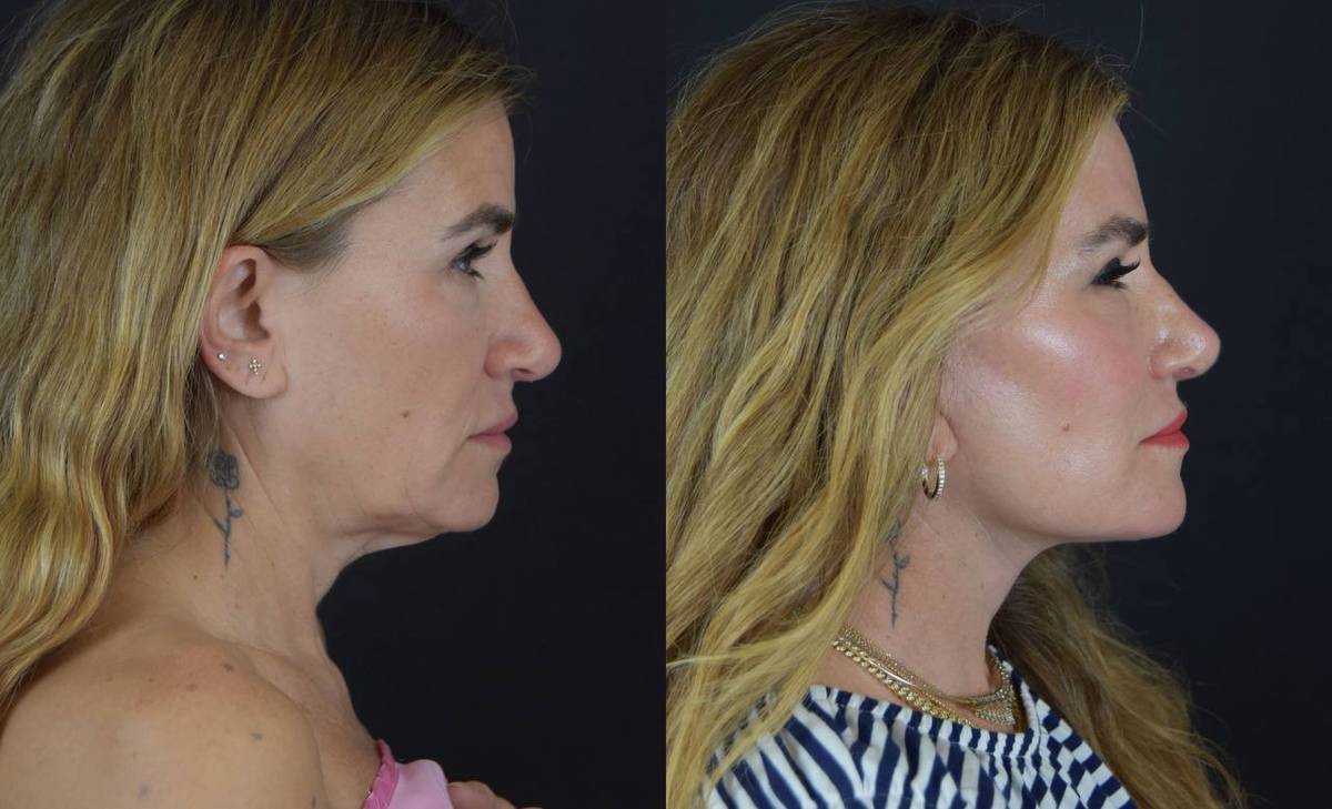 alli webb facelift photos