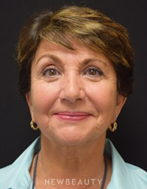 Dr. Jeffrey B. Wise - Facelift - After