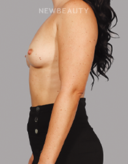 Dr. Mahabir - Breast Aug & Implants - 20152135 - Before