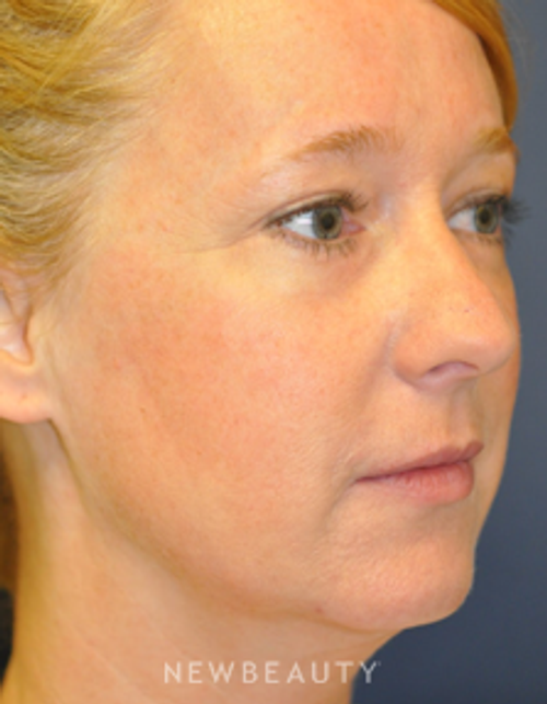 Drs. Lieberman & Parikh - Lower Blepharoplasty - After