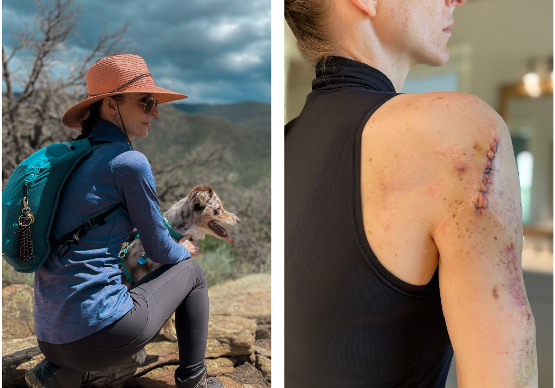 plit image showing melanoma survivor Amy Nichole: left side shows her outdoors hiking with a small dog, wearing a wide-brimmed sun hat, sunglasses, and blue jacket with teal backpack against a mountain landscape; right side shows her back and arm with visible surgical scars from melanoma removal