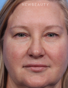 Dr. Kelly Bomer - Blepharoplasties - Before