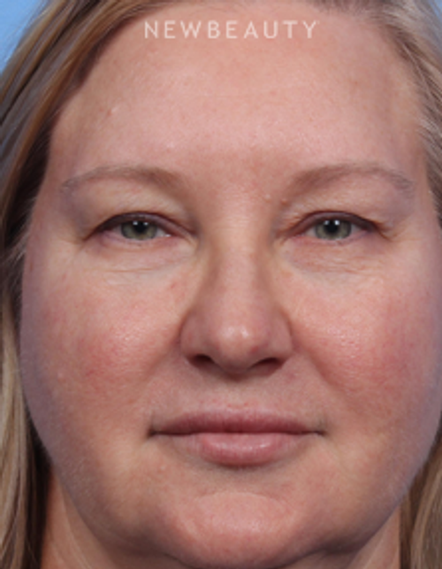 Dr. Kelly Bomer - Blepharoplasties - Before