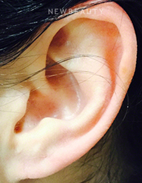 Dr. Kally Papantoniou - Earlobe Repair - After