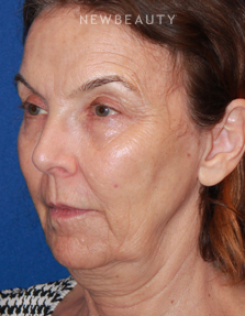 Dr. Dilip Madnani - Facelift & Necklift - Before