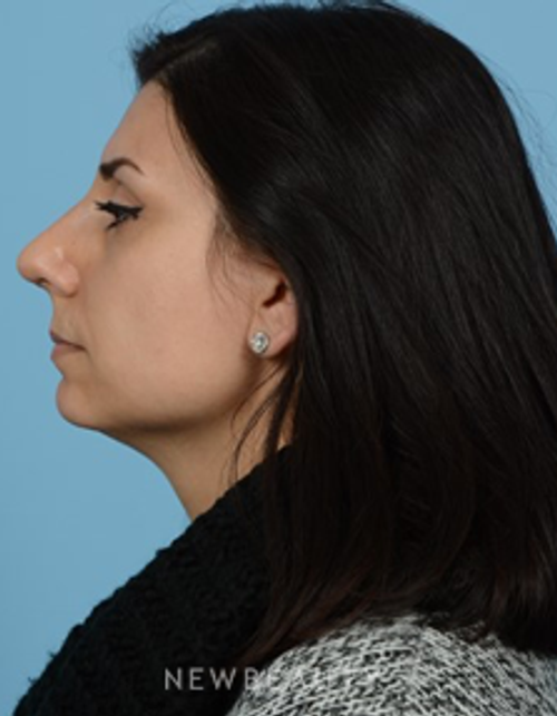 Dr. Jeffrey B. Wise- Rhinoplasty - After