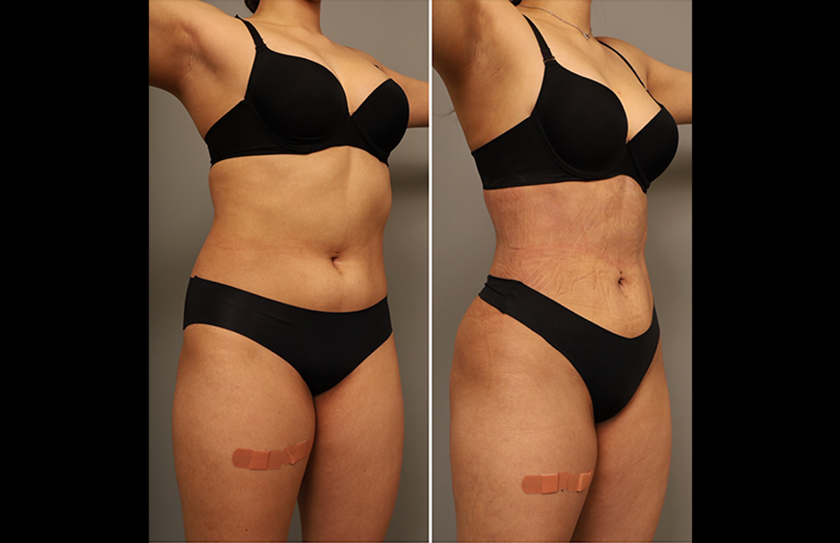 before and after RibXcar