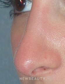 Dr. Min Ahn - Rhinoplasty - After
