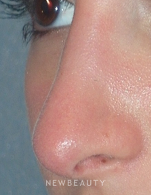 Dr. Min Ahn - Rhinoplasty - After