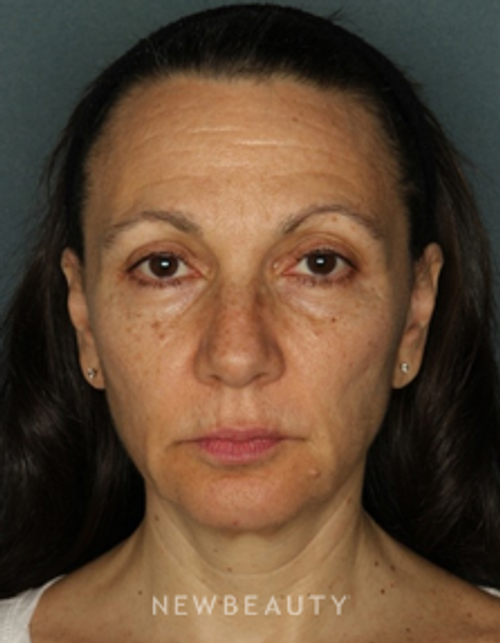Dr. Doris Day - Injectables & Fillers, Chemical Peel & Skin Tighteners - Before