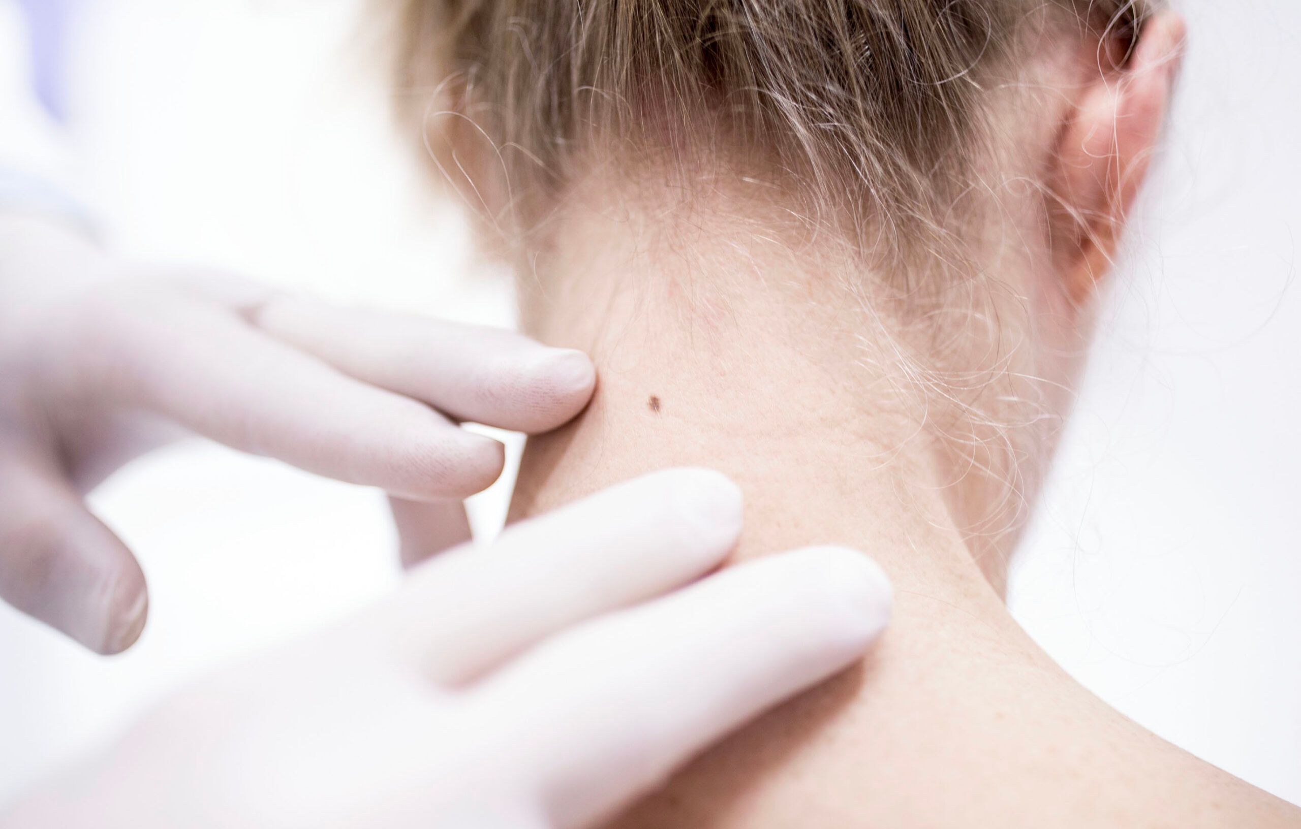 non-melanoma skin cancers