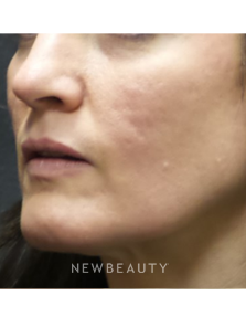 Dr. Jody Levine - Acne Scars - After