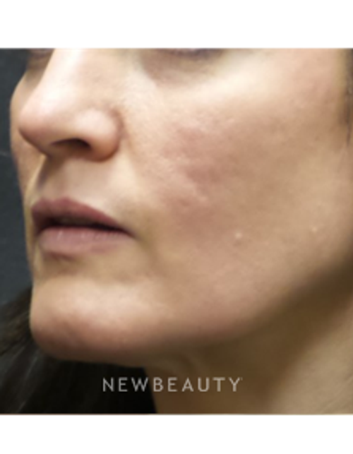 Dr. Jody Levine - Acne Scars - After