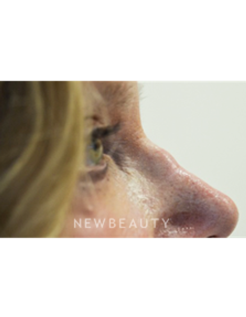Dr. Julie Russak Non Surgical Rhinoplasty - Before