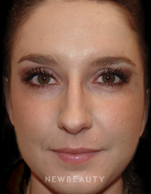 Dr. Joel Schlessinger - Youthful Rejuvenation - After