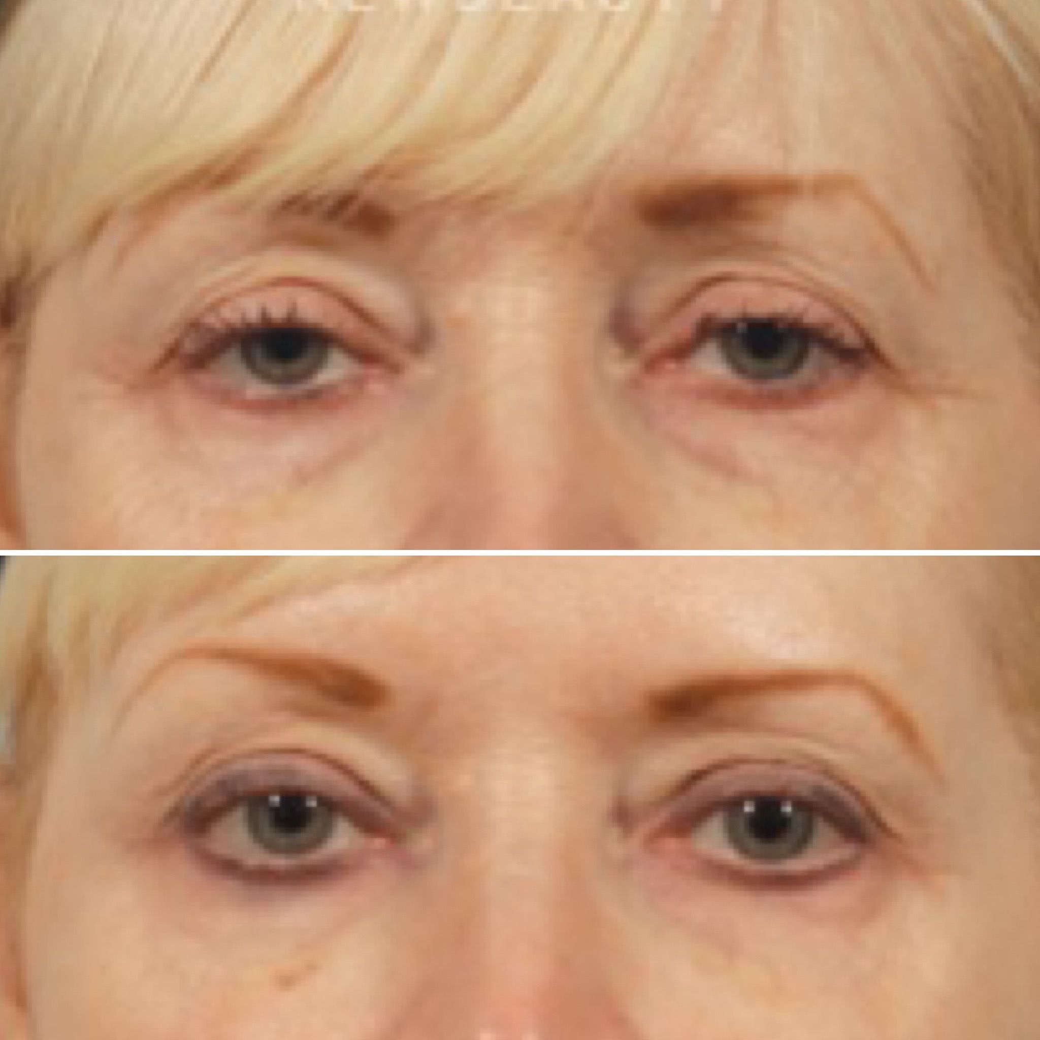 The "Botox Browlift"
