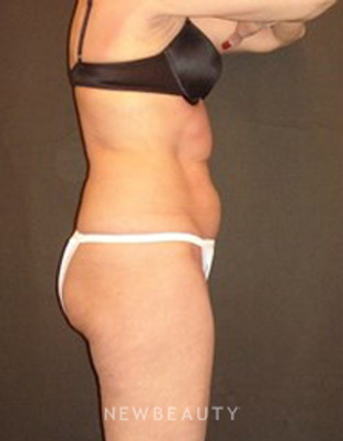 Dr. Joel Schlessinger - SmartLipo - Before
