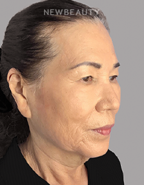 Dr. Sheila Barbarino-Blepharoplasty-5479898 - Before