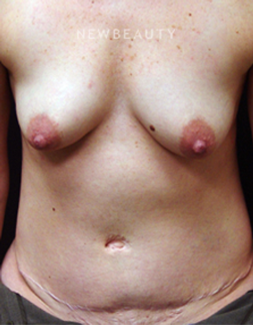 Dr. Mokhtar Asaadi Breast Implants, Tummy Tuck - Before