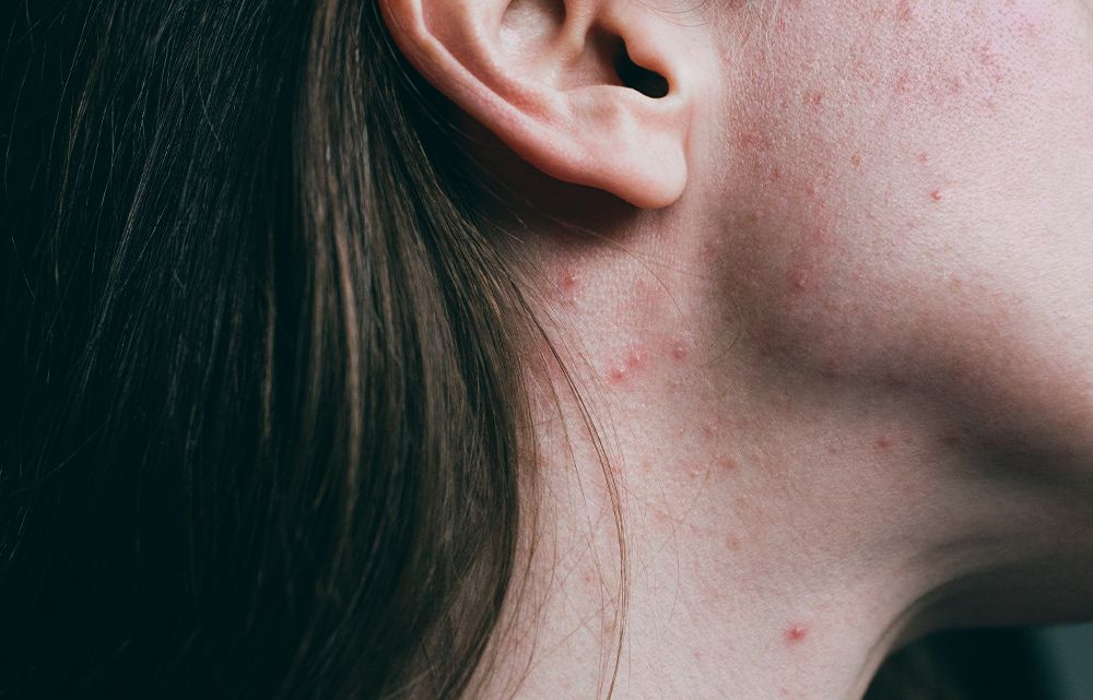 Accutane Before and After: Here’s What I Wish I Knew Before Starting Isotretinoin