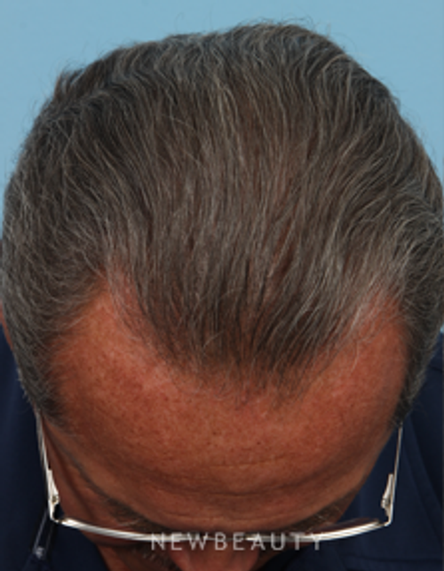 Dr. Kathleen Behr - Hair Loss Treatment - After