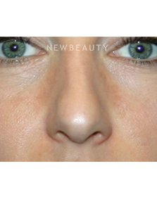 Dr. Kelly Bomer - Nonsurgical Rhinoplasty - Before