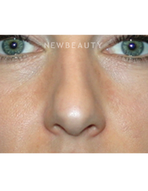 Dr. Kelly Bomer - Nonsurgical Rhinoplasty - Before
