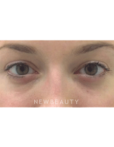 Dr. Julie Russak Injectables & Fillers Belotero - After