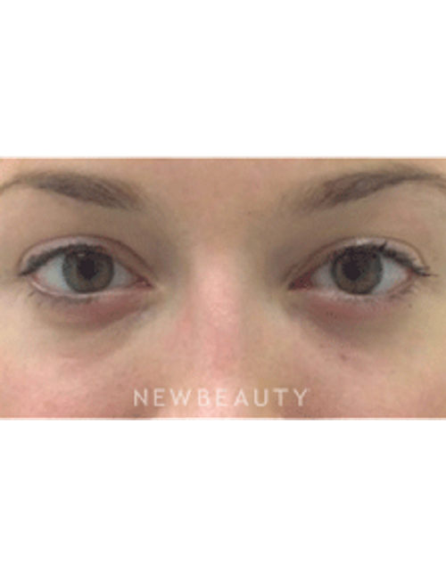 Dr. Julie Russak Injectables & Fillers Belotero - After