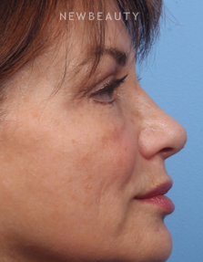 Dr. Kelly Bomer - Pleasant Profile - After