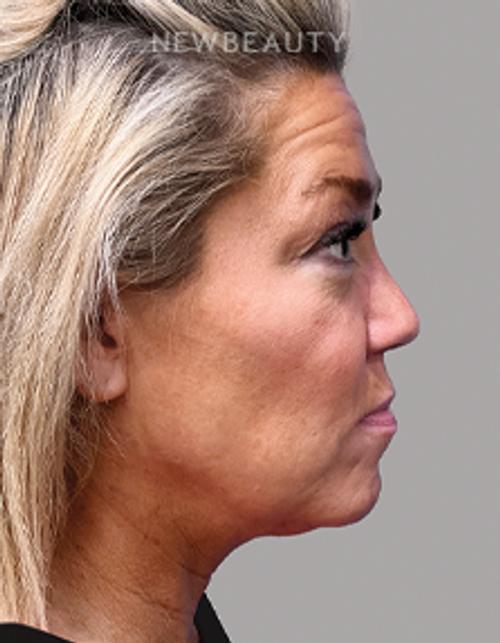 Dr. Michael A. Epstein - Elegant Facial Rejuvenation - 33109024 - Before