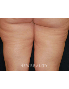 Dr. Kenneth Beer Lasers - Cellulite Treatment - After