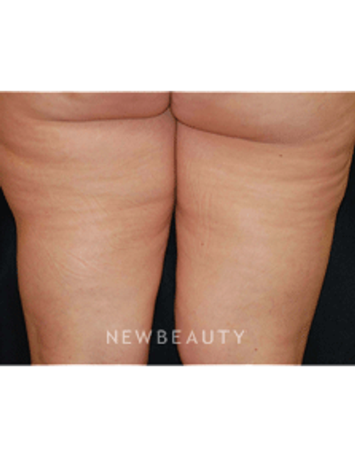 Dr. Kenneth Beer Lasers - Cellulite Treatment - After